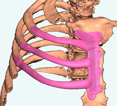 implantát z 3D tlačiarne